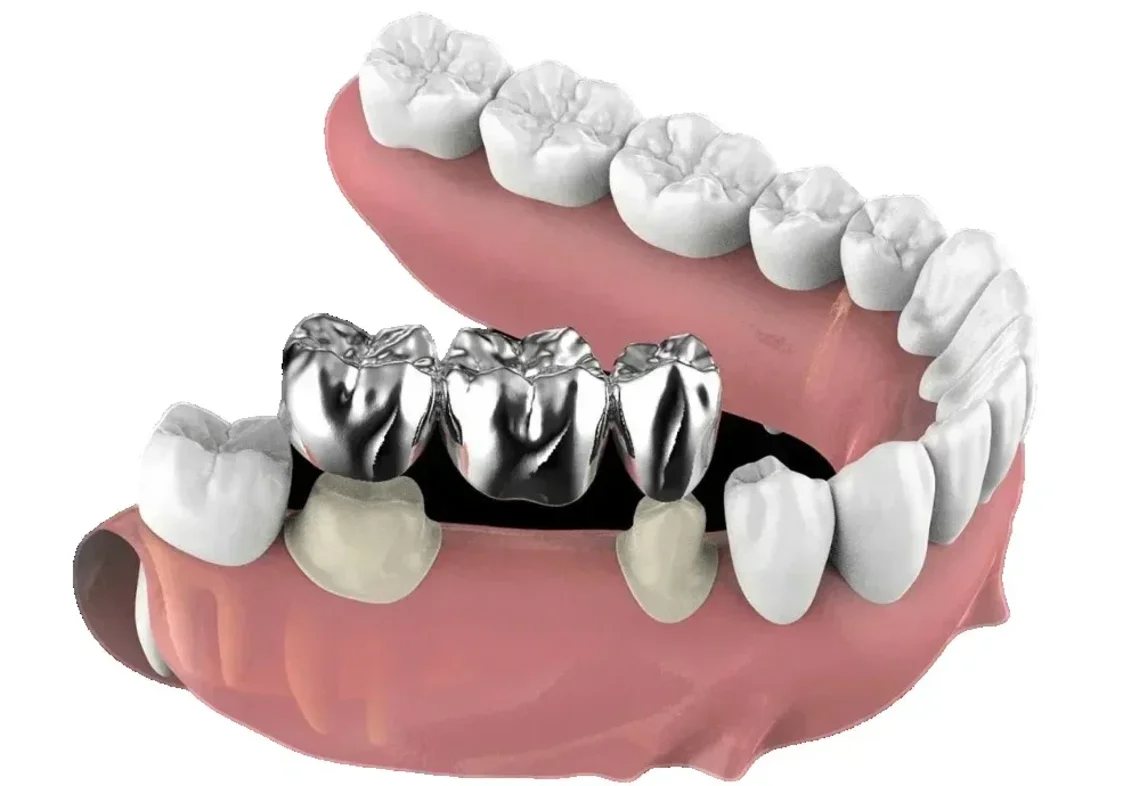 Протезирование зубов: цельнолитая коронка