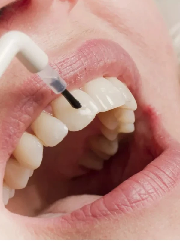 Фторирование зубов