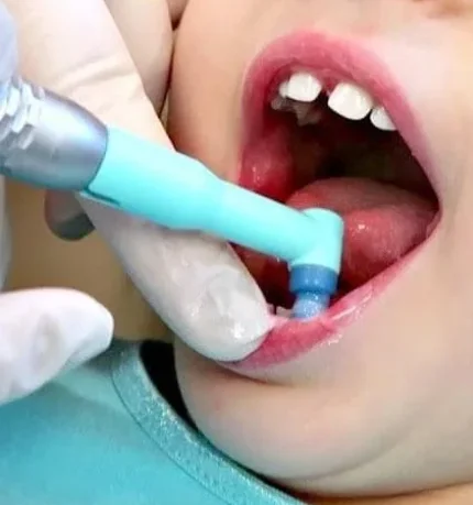 Профессиональная гигиена полости рта и зубов детская