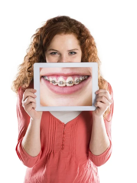 Фото для Ортодонтическое лечение брекетами Damon Clear