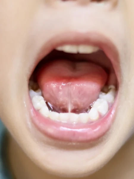 Фото для Коррекция уздечек языка, губы, рубцовых изменений слизистой