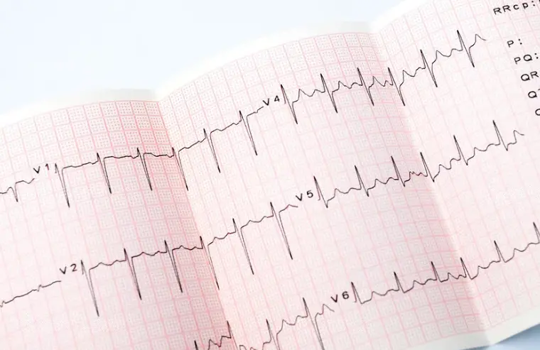 Электрокардиограмма сердца