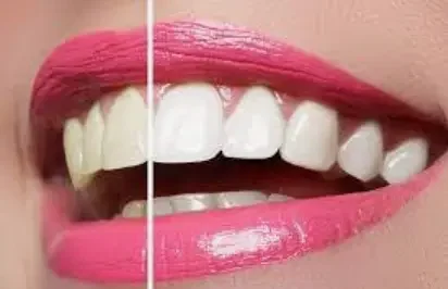 Отбеливание зубов ZOOM 3 (линия улыбки — 24 зуба)