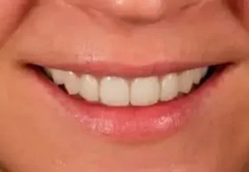 Эстетическая стоматология: реставрация коронки зуба линии улыбки. Исправляем длину и форму зубов, цвет эмали.
