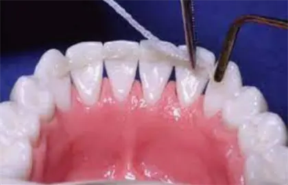 Шинирование зубов стекловолокном для предотвращения их расшатывания,  выпадения и   лечения пародонта.