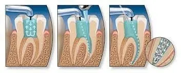 Пломбирование одного канала зуба